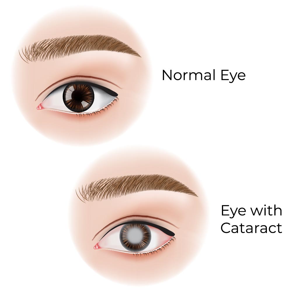 Focal Point Vision Cataract Surgery