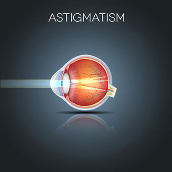 Astigmatism illustration