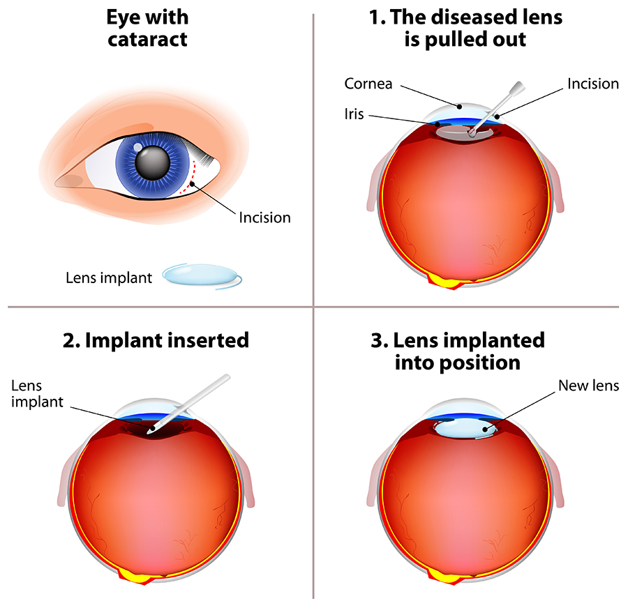 Cataract Surgery steps illustration