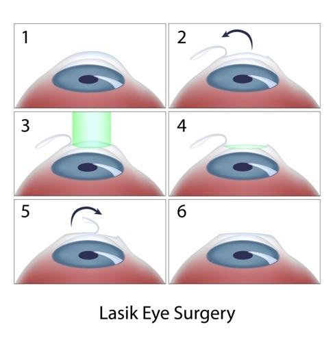 Steps of LASIK surgery illustration