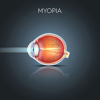 Myopia illustration